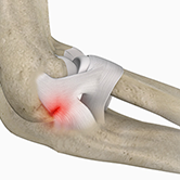 Lateral Ulnar Collateral Ligament Injuries (Elbow) Image