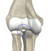 Loose Bodies in the Elbow Image