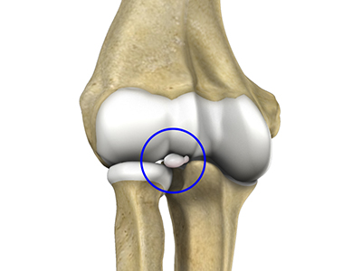 Loose Bodies in the Elbow - Educational Picture