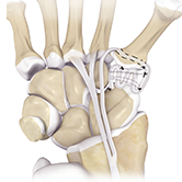 LRTI (Ligament Reconstruction and Tendon Interposition) for Thumb CMC Arthritis Image
