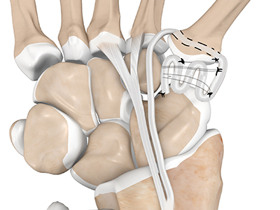 LRTI (Ligament Reconstruction and Tendon Interposition) for Thumb CMC Arthritis  - Educational Picture
