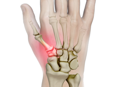 LRTI for Thumb CMC Arthritis - Educational Picture