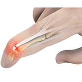 Mallet Finger Image