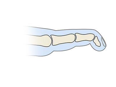 Mallet Finger - Educational Picture