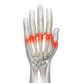 Metacarpophalangeal Joint Arthritis Image