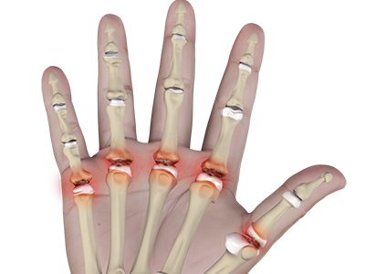 Metacarpophalangeal Joint Arthritis - Educational Picture