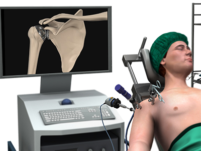 Minimally Invasive Shoulder Joint Replacement - Educational Picture