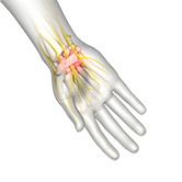 Nerve Decompression of the Upper Extremities Image