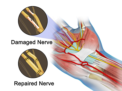 Nerve Transfers - Educational Picture