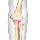 Nursemaid's Elbow Image