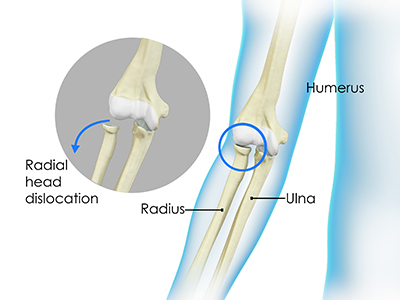 Nursemaid's Elbow - Educational Picture