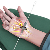 Open Carpal Tunnel Release Surgery Image