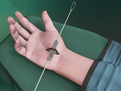 Open Carpal Tunnel Release Surgery - Educational Picture