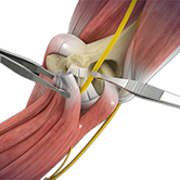 Open Cubital Tunnel Repair Image