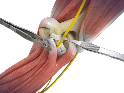 Open Cubital Tunnel Repair - Educational Picture