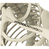 ORIF of Clavicle Fractures