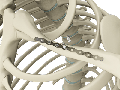 ORIF of Clavicle Fractures - Educational Picture