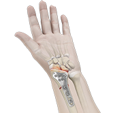 ORIF of Distal Radius Fracture Image