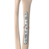 ORIF of Forearm Fractures Image