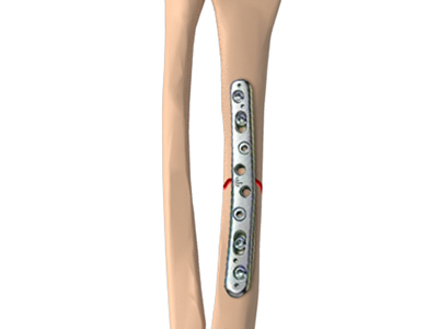 ORIF of Forearm Fractures - Educational Picture