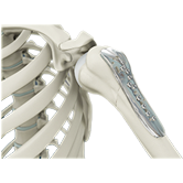 ORIF Proximal Humerus Fracture