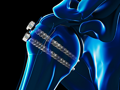 ORIF Proximal Humerus Fracture - Educational Picture