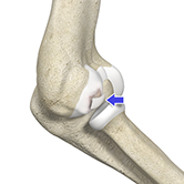 Osteochondritis Dissecans Image