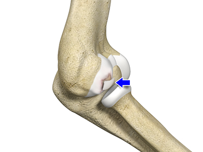 Osteochondritis Dissecans - Educational Picture