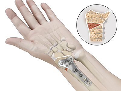 Osteotomy for Distal Radius Malunion - Educational Picture