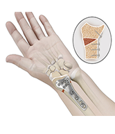 Osteotomy for Distal Radius Malunion Image