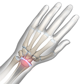 Partial Wrist Replacement Image