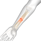 Pediatric Forearm Fracture Image