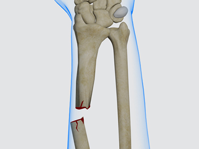 Pediatric Forearm Fracture - Educational Picture