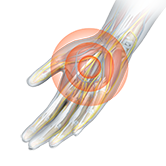 Post-traumatic Reconstruction of the Upper Extremity Image