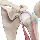 Proximal Biceps Tendon Rupture Image
