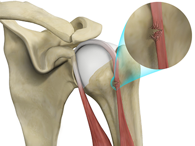 Proximal Biceps Tendon Rupture - Educational Picture