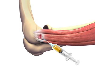 Platelet-Rich Plasma (PRP) for the Elbow - Educational Picture