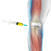 PRP Procedure for Tennis Elbow Image