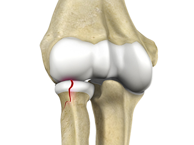 Radial Head Fractures of the Elbow - Educational Picture