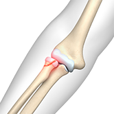 Radial Head Fractures of the Elbow Image
