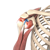 Rotator Cuff Tear Image