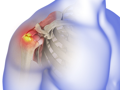 Rotator Cuff Tear - Educational Picture