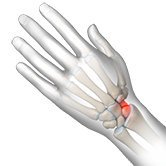 Scaphoid Fracture Image