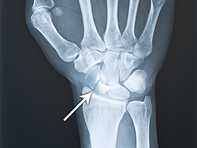 Scaphoid Fracture - Educational Picture