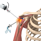 Shoulder Arthroscopy