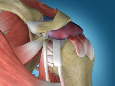 Shoulder Impingement Treatment - Educational Picture