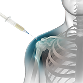 Shoulder Injections