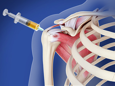 Shoulder Injections - Educational Picture