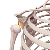 Shoulder Instability Image