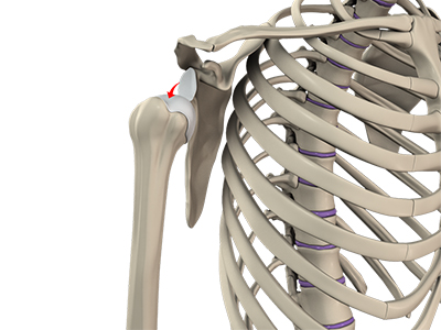 Shoulder Instability - Educational Picture